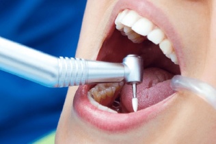 عصب کشی مجدد دندان (ری اندو)