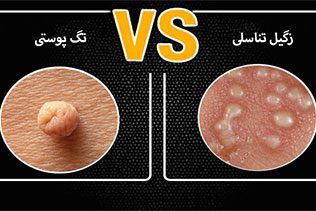 تفاوت تگ پوستی با زگیل تناسلی