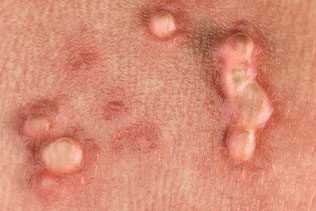 سوالات متداول درباره زگیل تناسلی