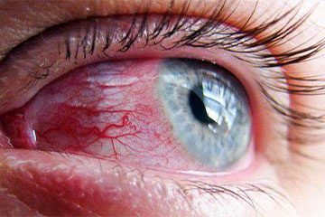 قرمزی چشم