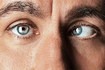 انحراف چشم چیست ؟
