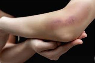 علت کبودی های بی دلیل