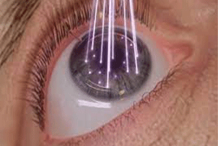 سن مناسب لازک و لیزیک چشم