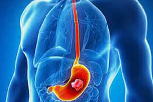 زخم معده چگونه به وجود می آید ؟