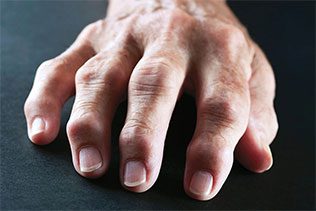 روماتیسم مفصلی