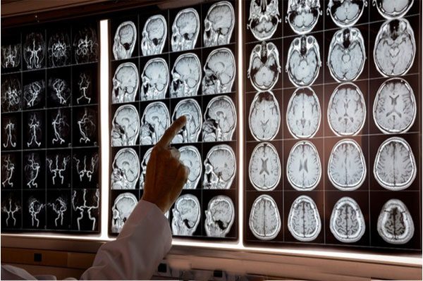 بهترین متخصص مغزعصاب دکتر آوید رکنی