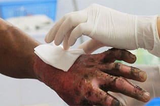 کمک های اولیه هنگام سوختگی کدام اند؟